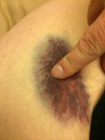 bruise1